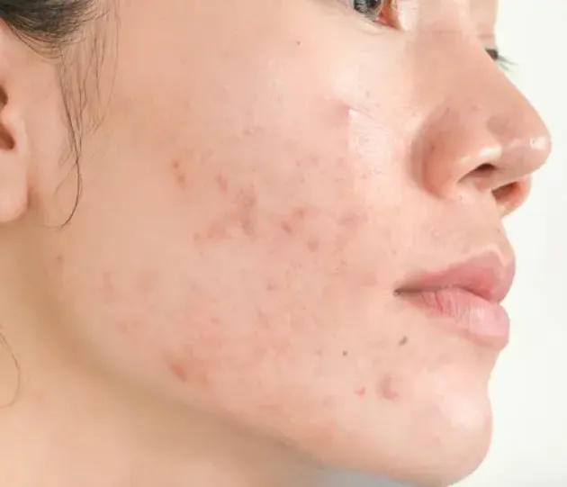 Acne and acne scarring treatment at Wellface
