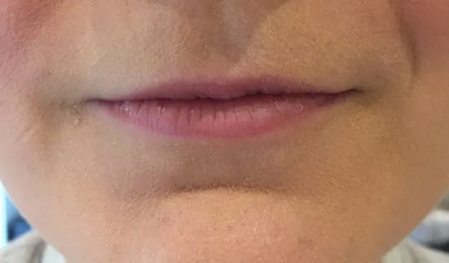 Thin lips treatment at Wellface