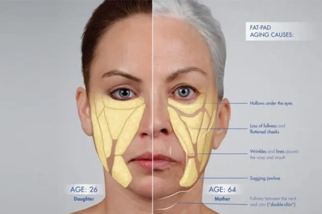 Facial volume and definition treatment at Wellface