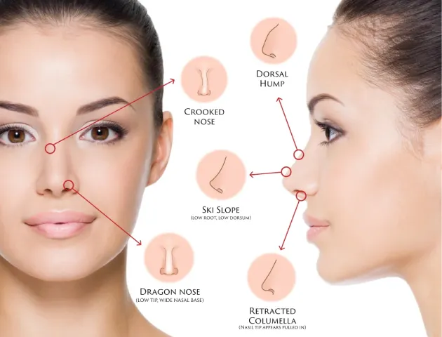 Nose reshaping treatment at Wellface