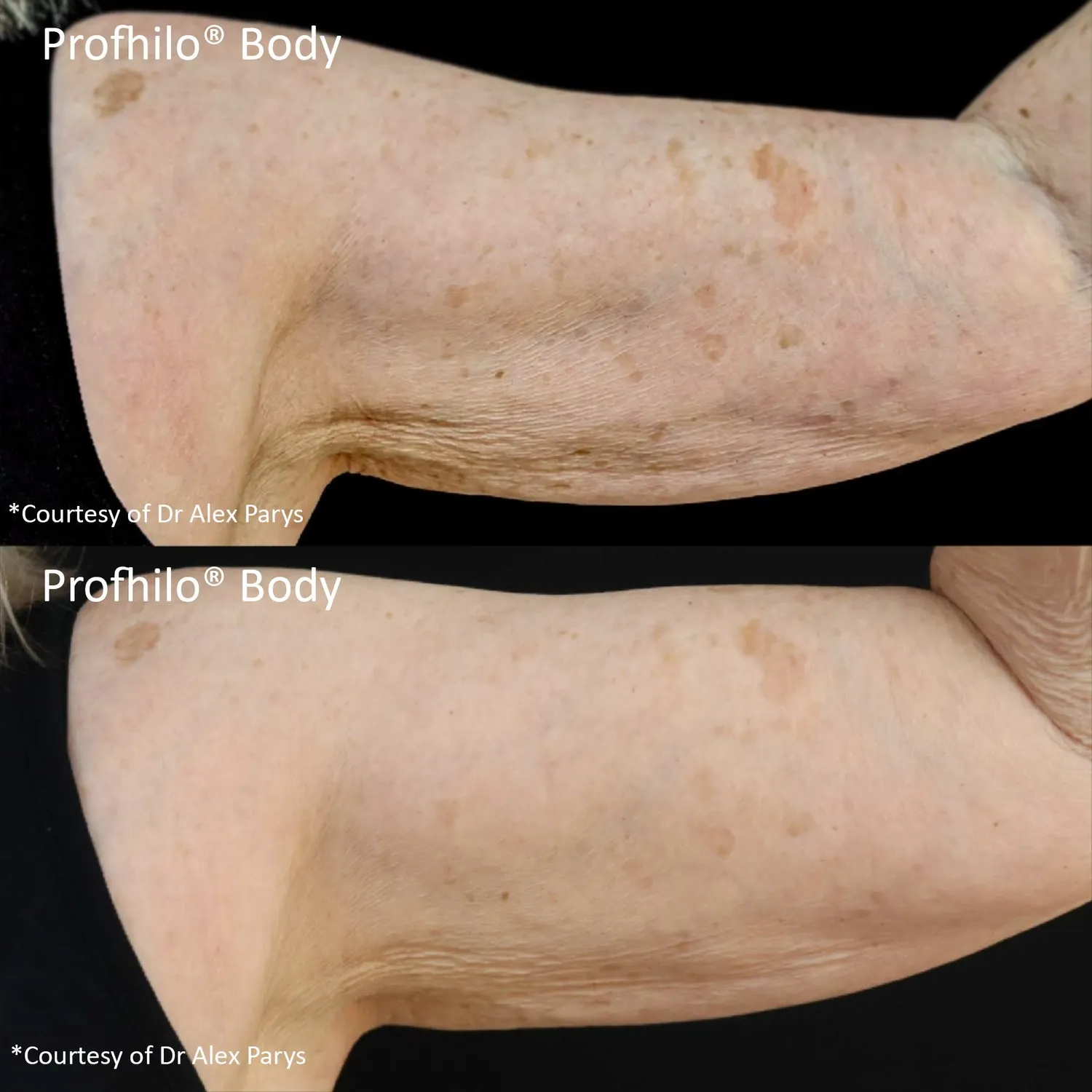 PROFHILO Body treatment