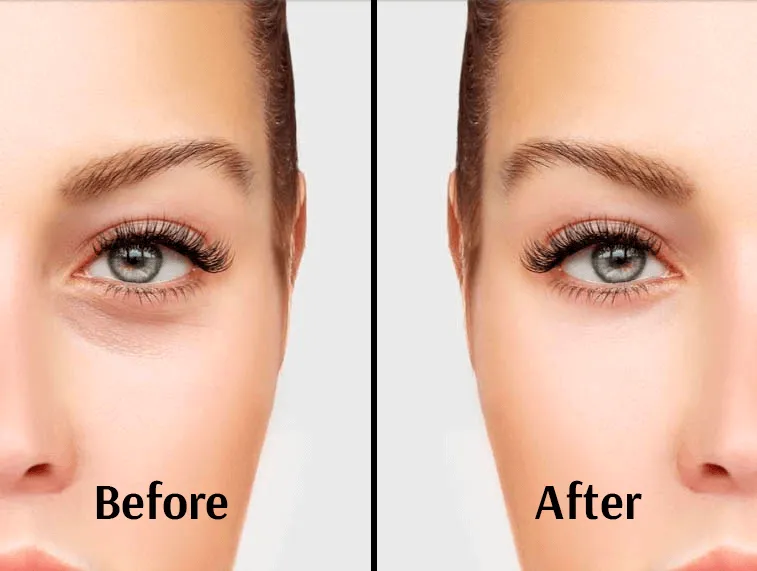 Brighter under-eyes before and after tear trough filler at Wellface Wimbledon