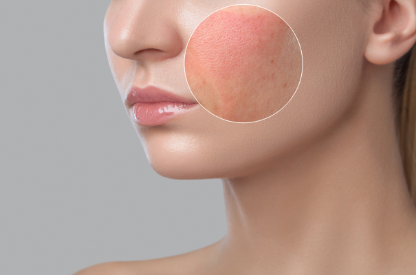 Natural-looking Blue Peel Radiance results at Wellface Cobham
