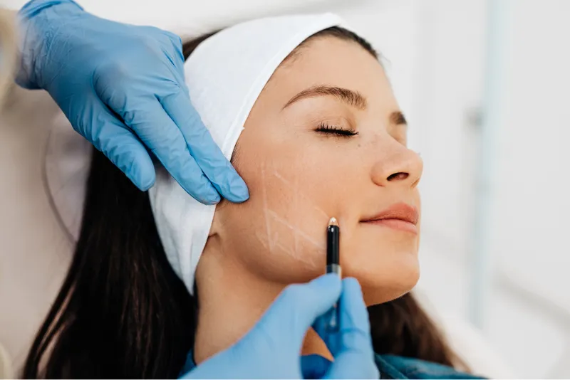 A balanced, defined profile after jaw and chin filler at Wellface Wimbledon