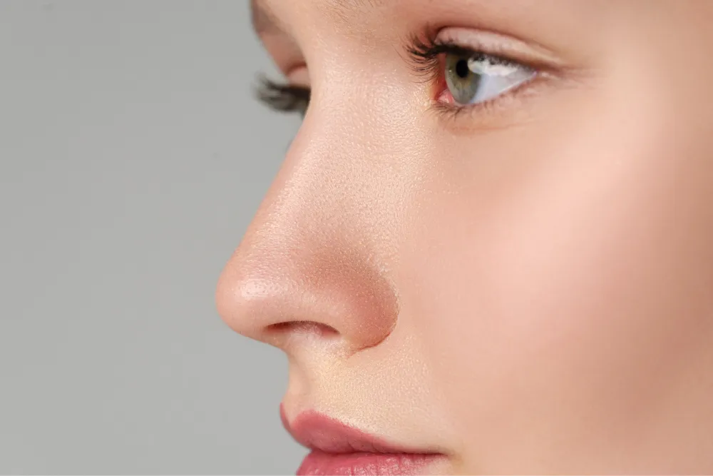 Natural-looking non-surgical rhinoplasty results at Wellface Cobham