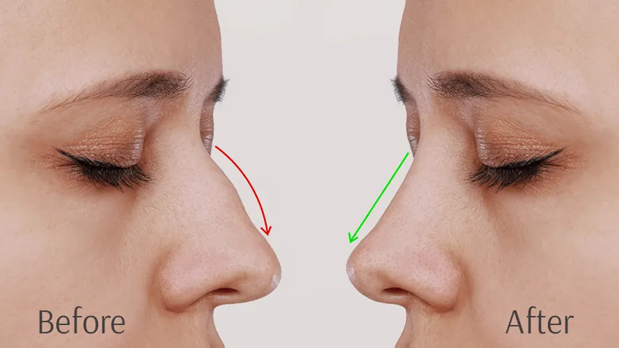 A refined nasal profile after non-surgical rhinoplasty at Wellface Wimbledon