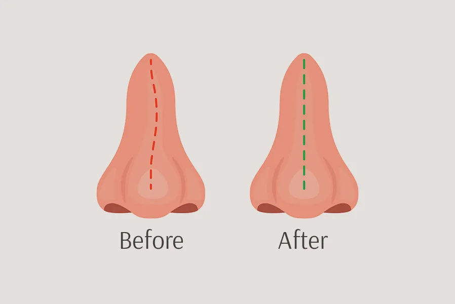 The areas of the nose refined during non-surgical rhinoplasty at Wellface Cobham