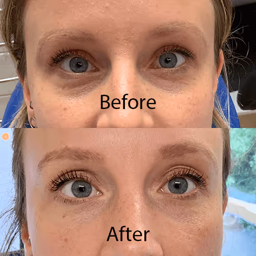 Skin quality rebuilt over a course of regenerative treatment
