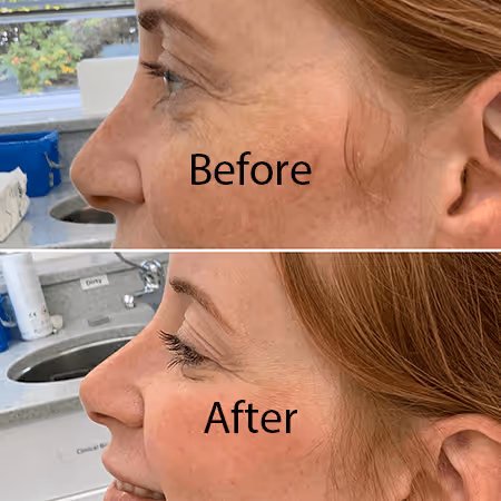 Skin booster results: hydration you can see in the skin