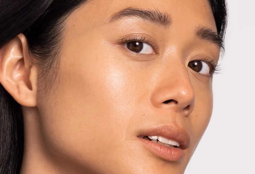 Natural-looking microneedling results at Wellface Wimbledon