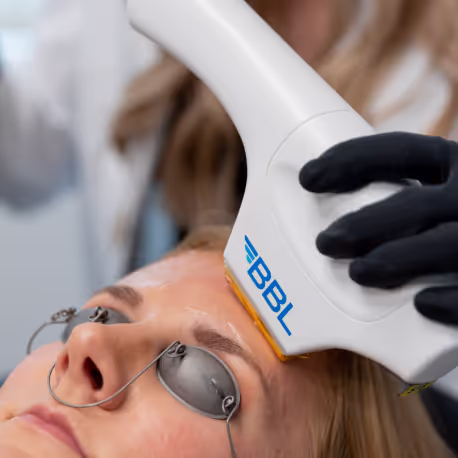 BBL Hero BroadBand Light treatment at Wellface Cobham