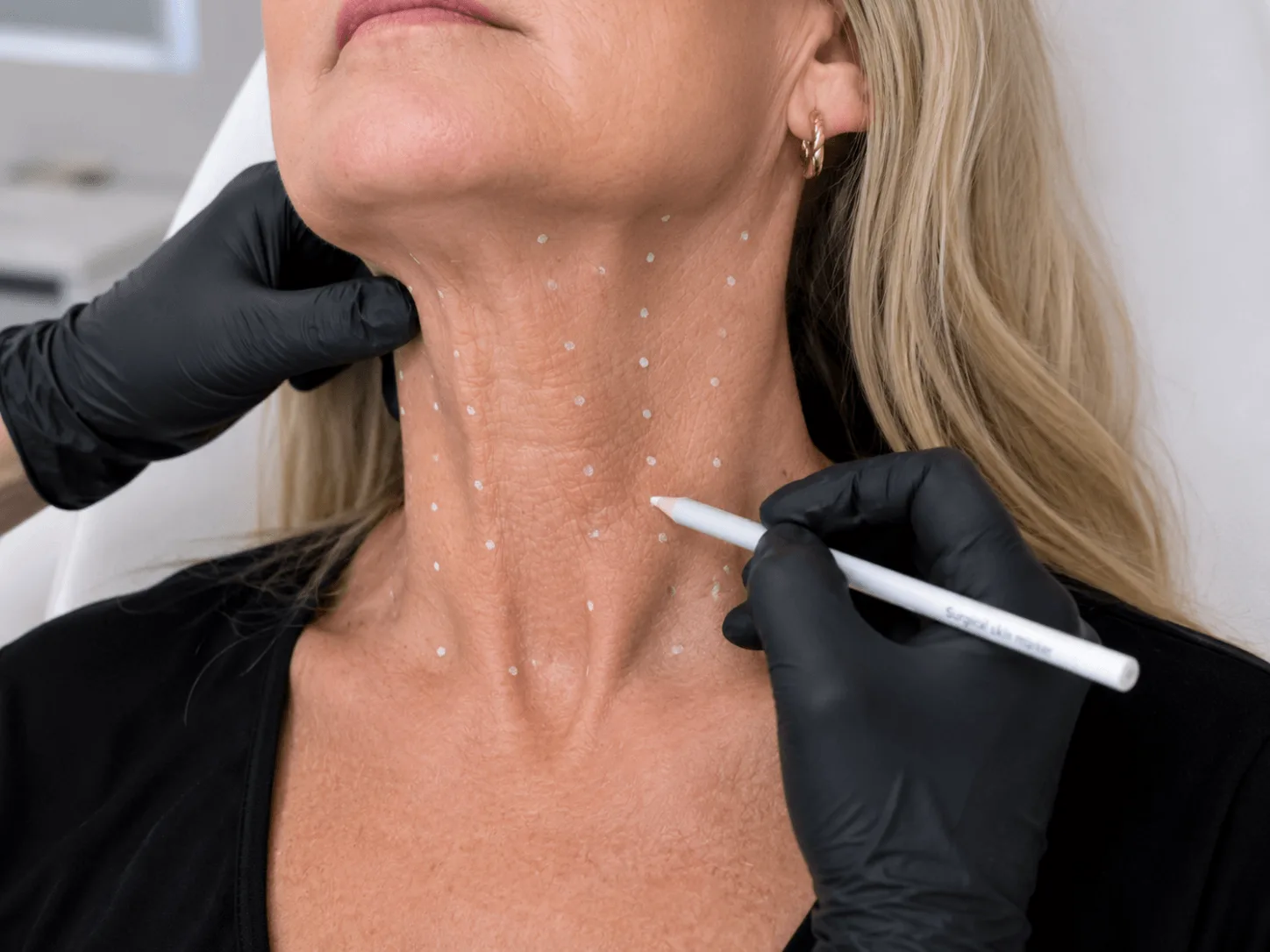Marking the injection points for neck treatment at a consultation
