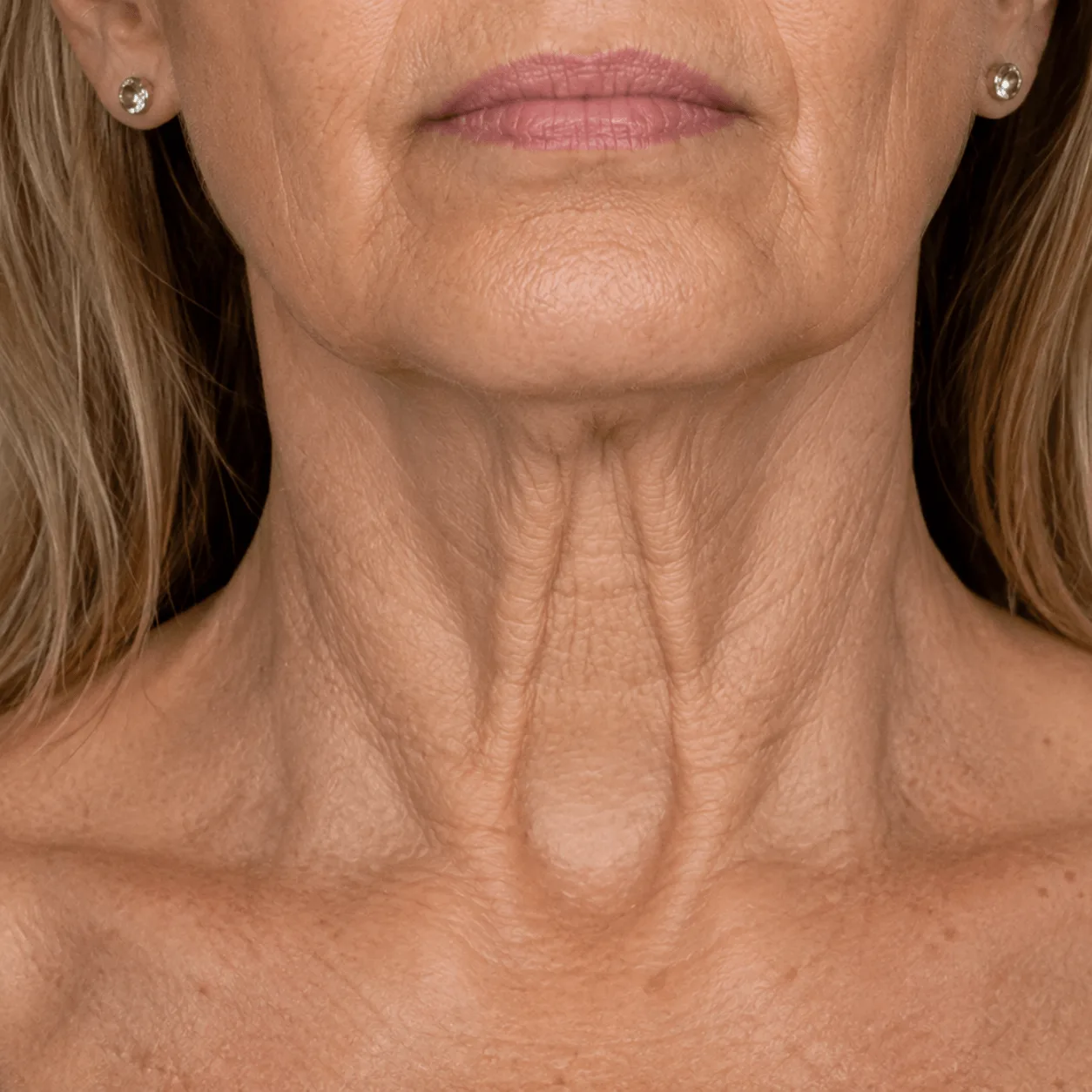Loose skin and platysmal bands on the neck, the concerns neck treatment addresses