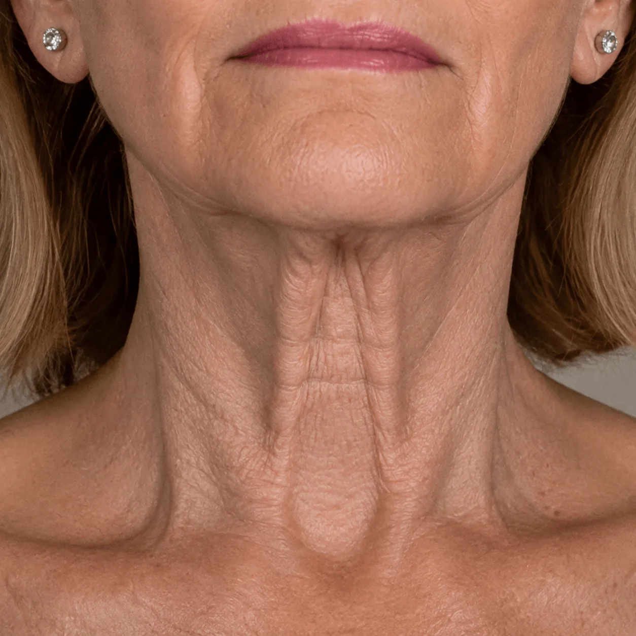 Platysmal bands and loose neck skin, the concerns neck treatment addresses